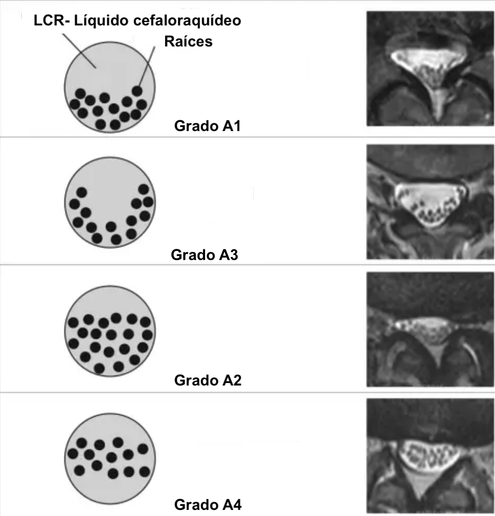 grado de compresión del saco dural lumbar