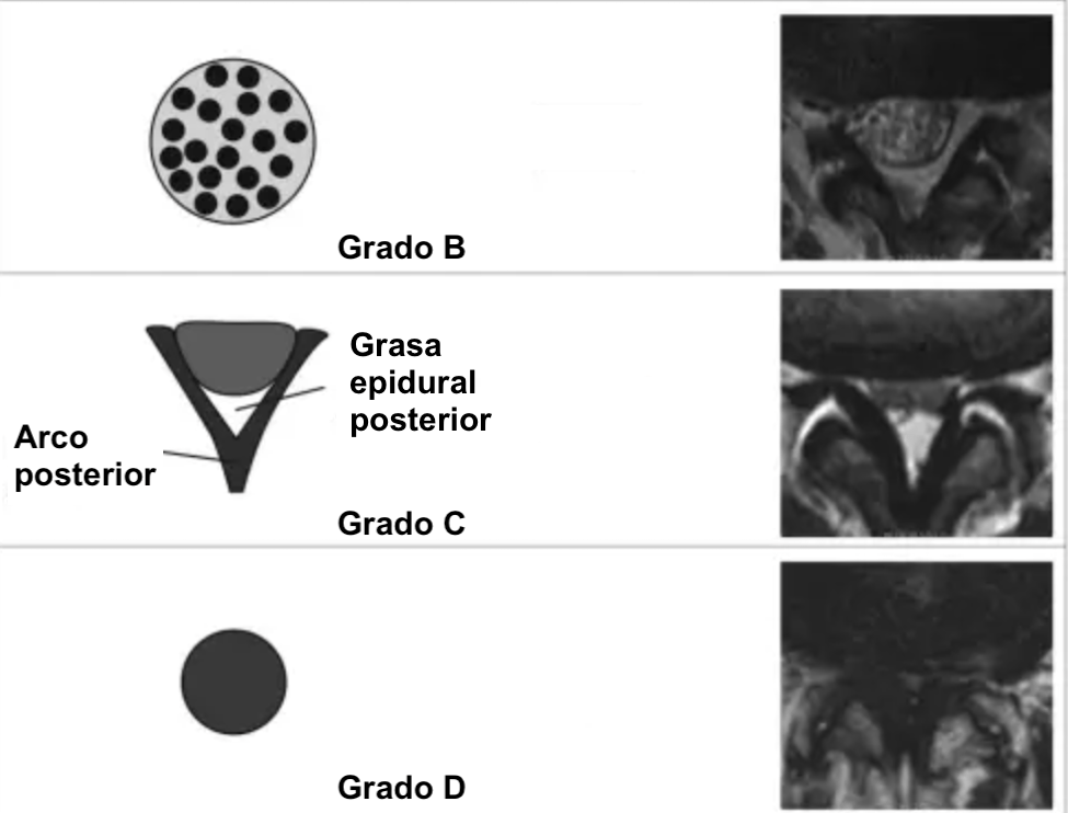 grado de compresión del saco dural lumbar